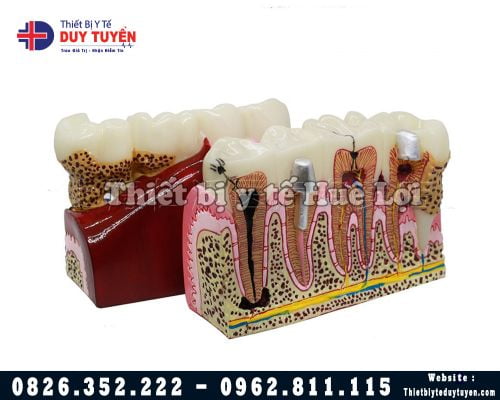 Mô hình răng nội nha