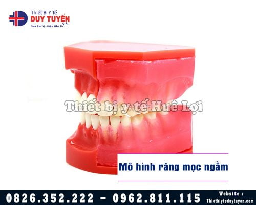 Mô hình răng mọc ngầm