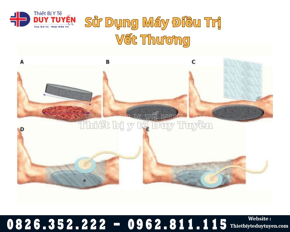 sử dụng máy điều trị vết thương