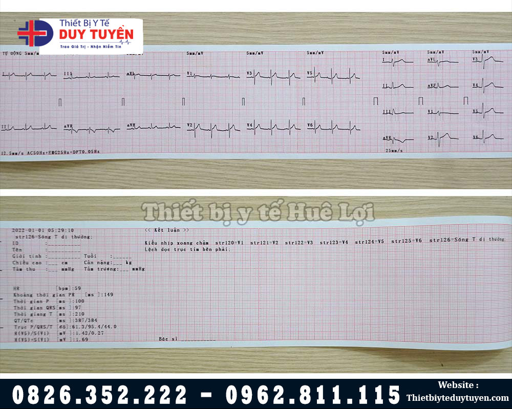 Phiếu in kết quả máy điện tim 300G