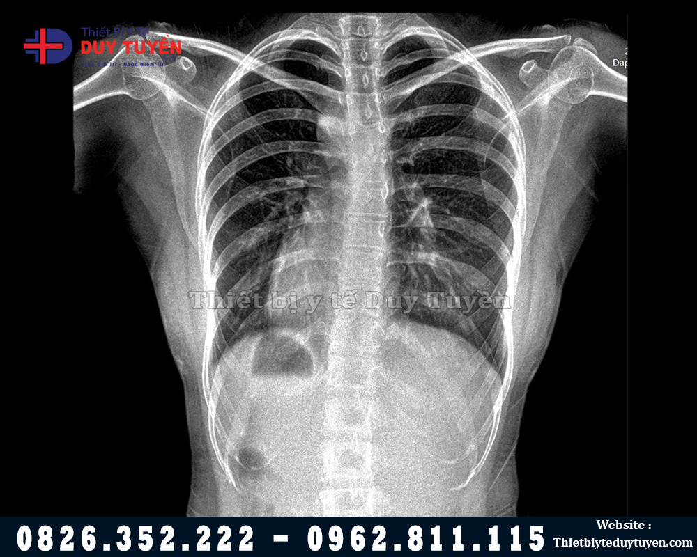 Hình ảnh chụp X Quang trên máy Yolong