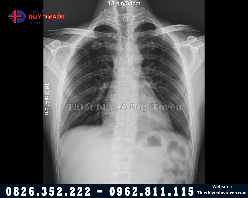 Hình Ảnh Chụp X Quang Bằng Máy YOLONG