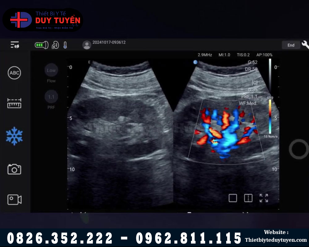 hình ảnh máy siêu âm C5