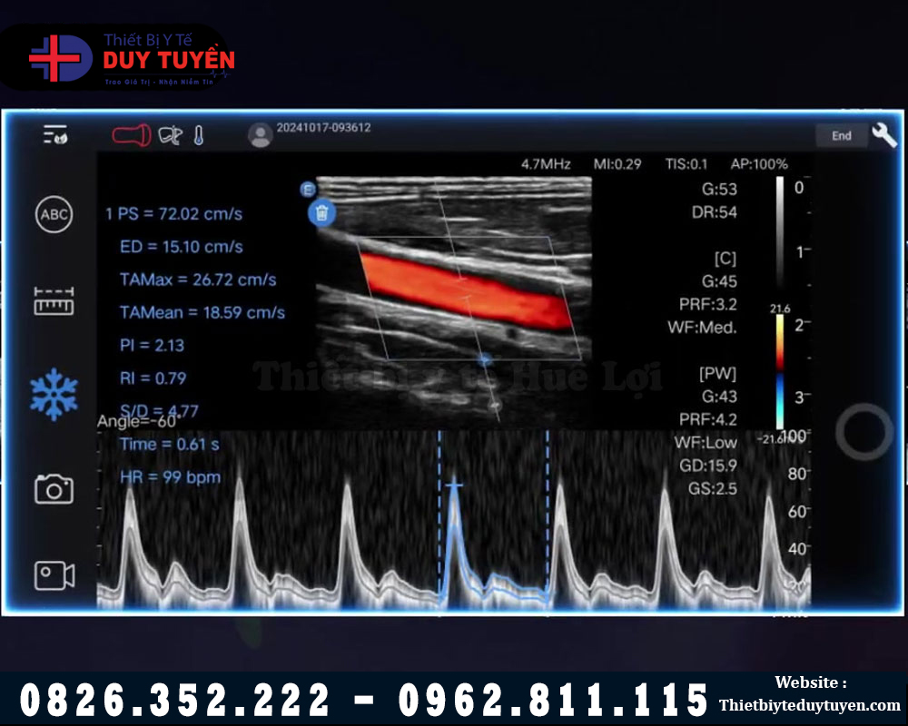 máy siêu âm mini cầm tay c5 hình ảnh dõ nét