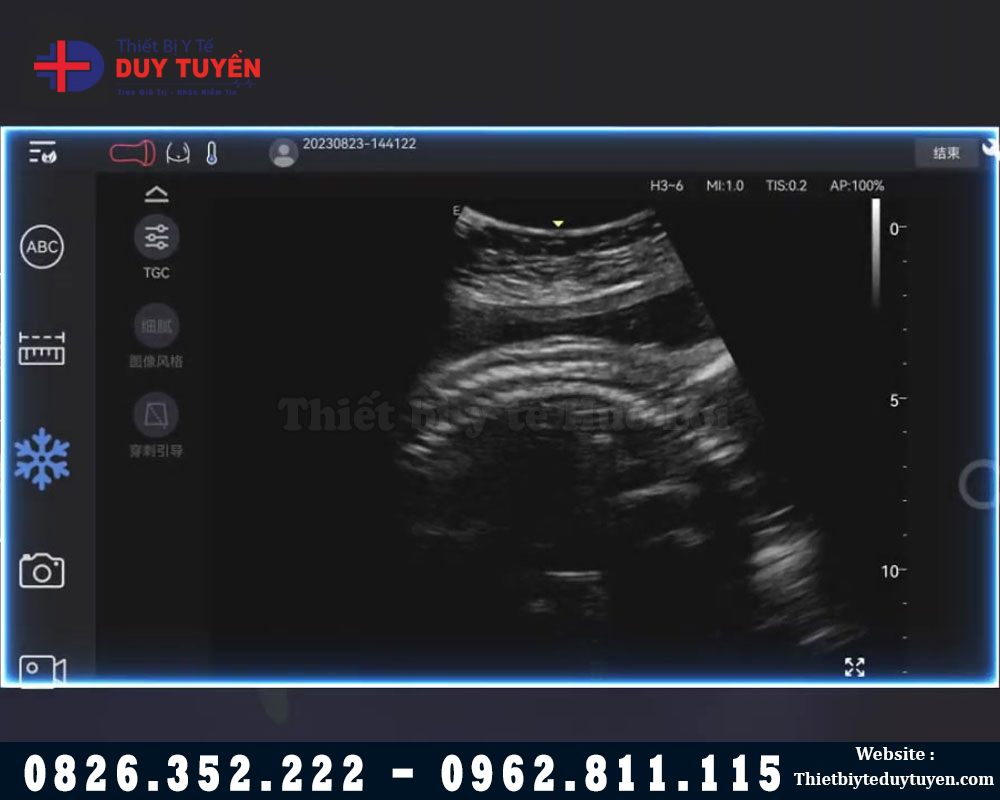 siêu âm bằng máy EDAN MINI C5