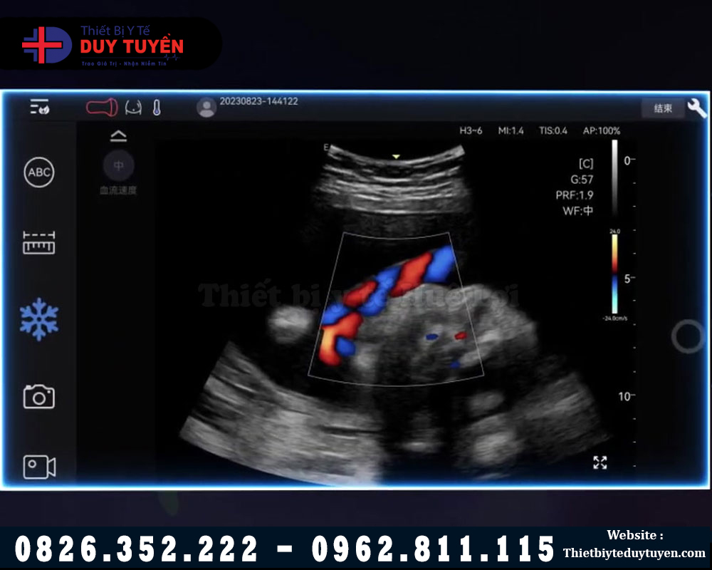 siêu âm dõ nét bằng máy Edan c5