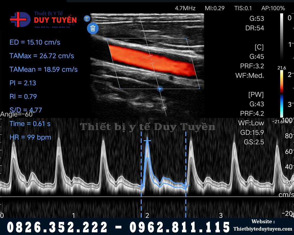 hình ảnh máy siêu âm cầm tay EDAN L12