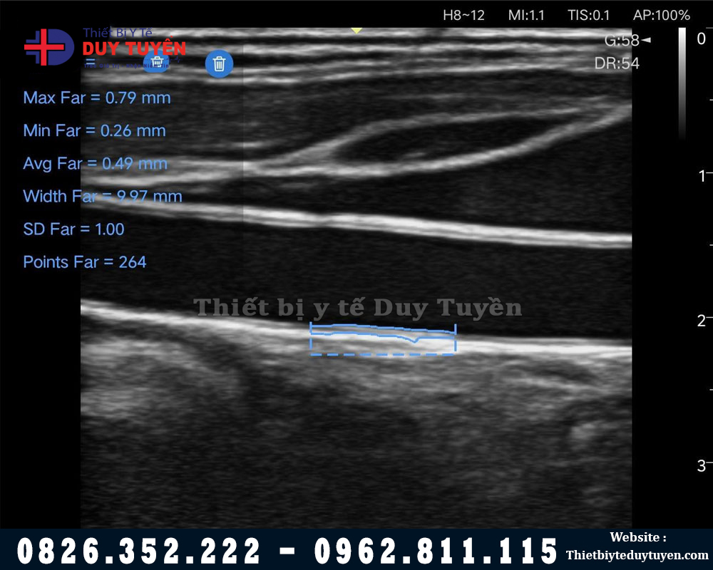 hình ảnh trên máy siêu âm cầm tay