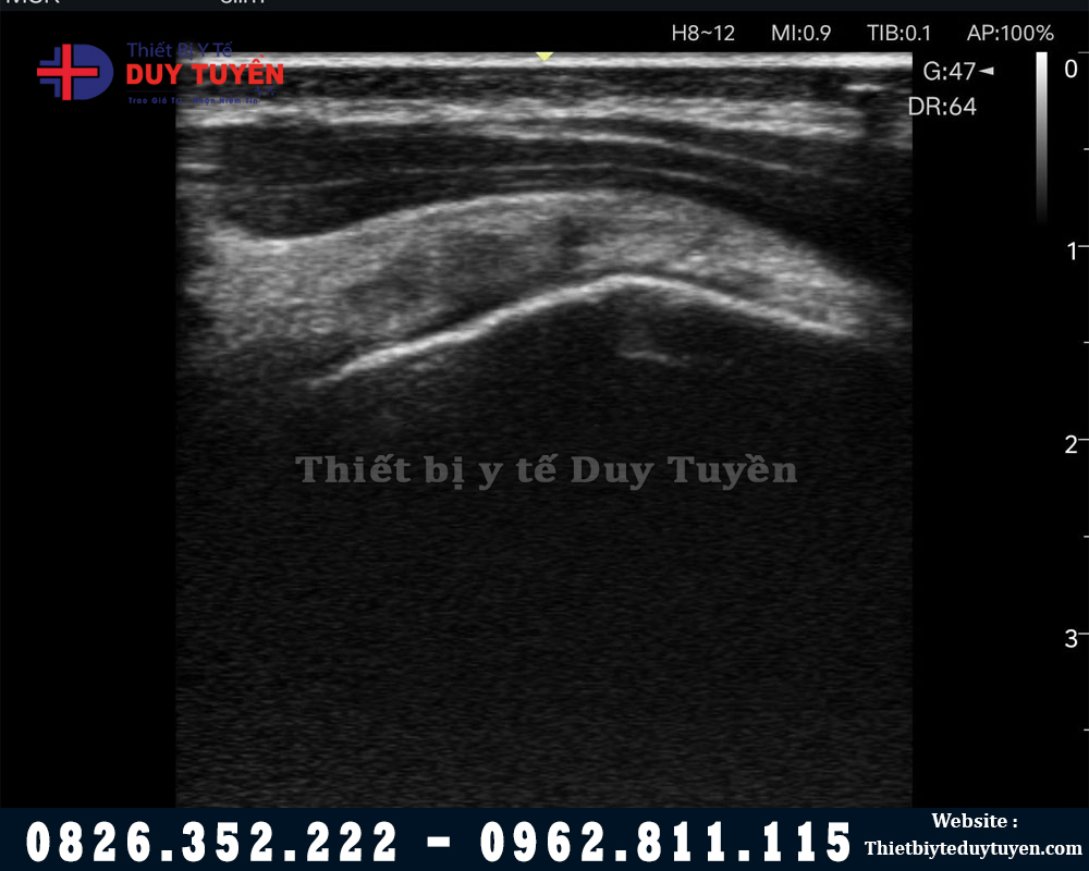 kết quả trên máy siêu âm EDAN L12