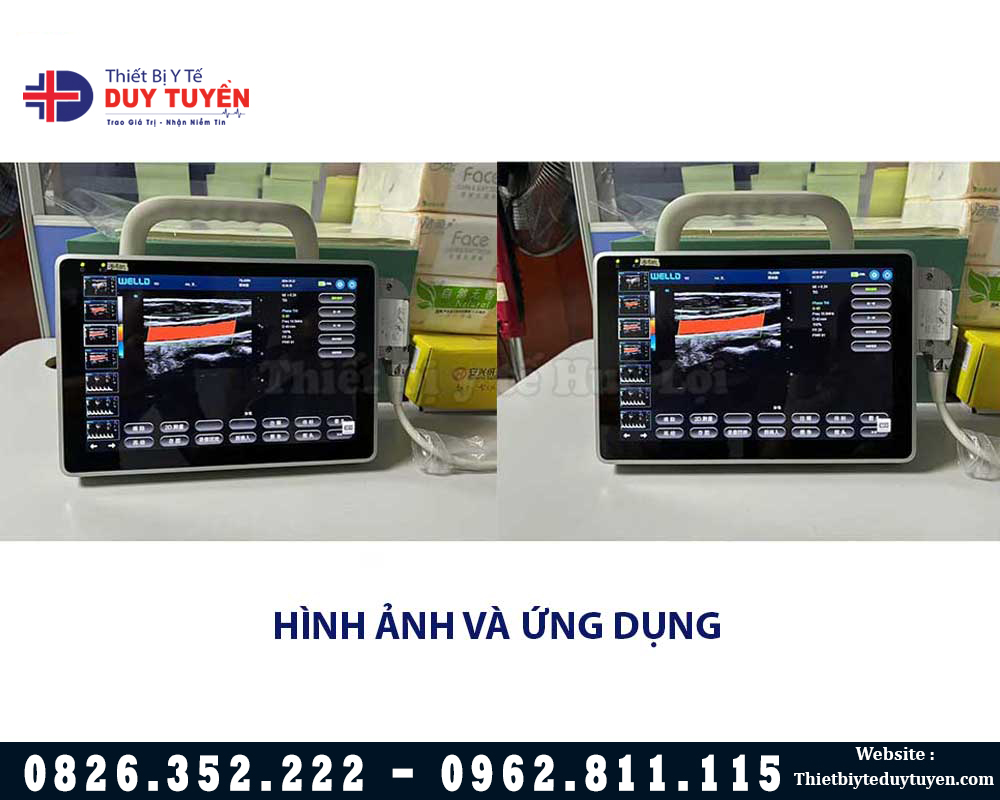 máy siêu âm doppler màu nhỏ gọn