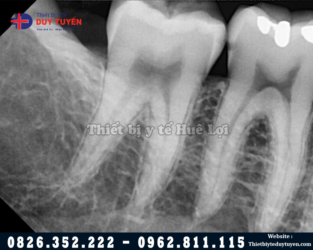Chất lượng hình ảnh chụp x quang răng cầm tay