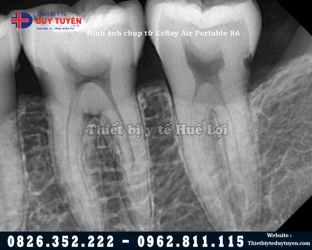 Hình ảnh máy chụp X Quang răng cầm tay vatech