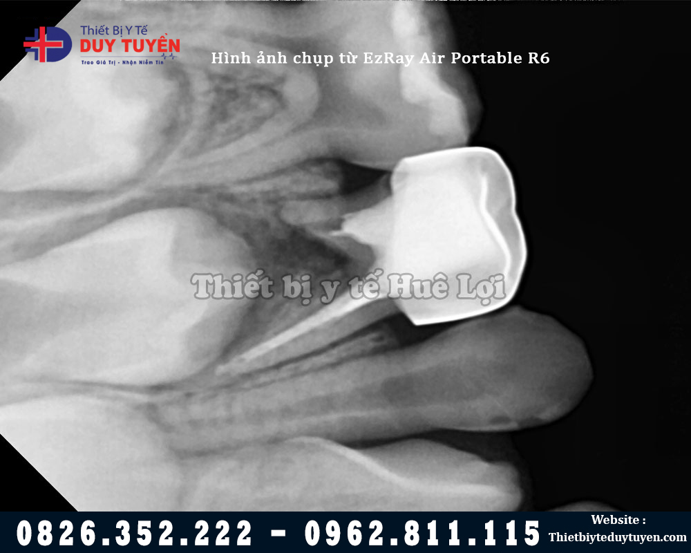 Hình ảnh chụp x quang răng bằng máy Vatech
