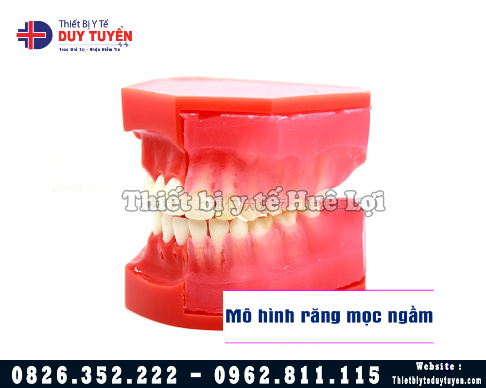 mô hình răng mọc ngầm